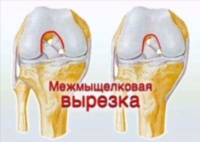 Общие принципы реабилитации при разрыве передней крестообразной связки