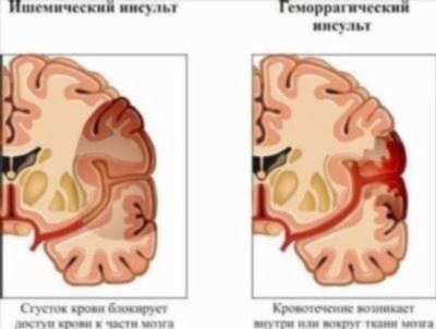 Сколько времени длится больничный после ишемического инсульта?